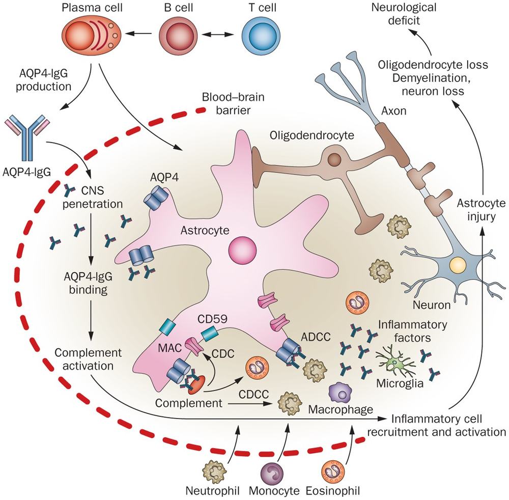 Medical diagram of AQP4-IgG antibodies crossing the blood-brain barrier, damaging astrocytes and causing neuron loss
